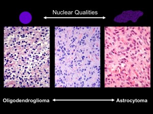 Under the microscope, the shapes of cell nuclei in brain tumors look different depending on the type of tumor.